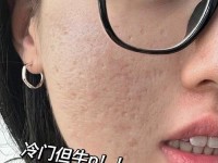 以瓷肌祛痘，告别烦恼（探究以瓷肌祛痘的神奇效果与方法）